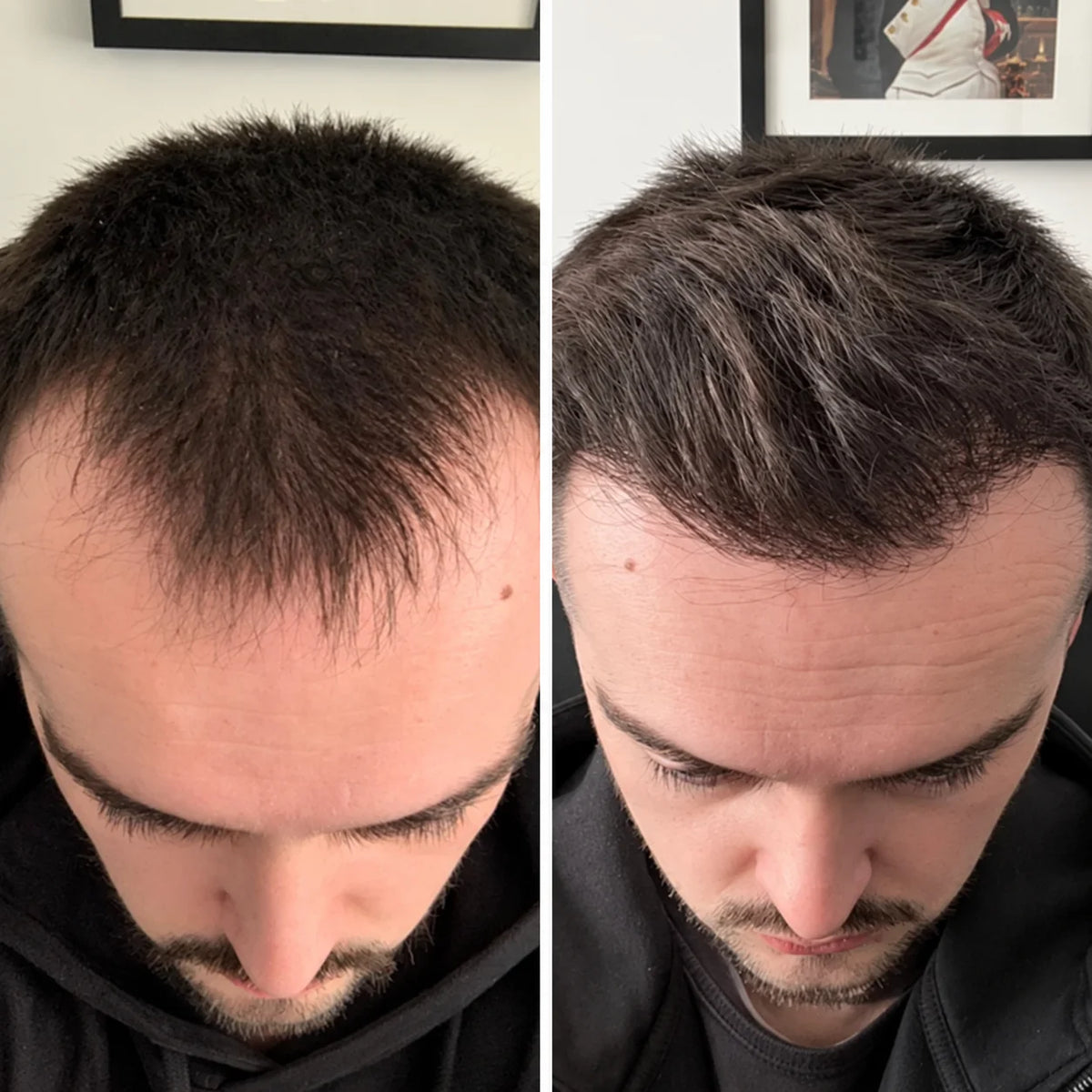 Hårvekstserum roll-on – for tynt hår